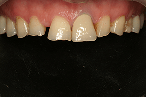 ציפוי לשיניים