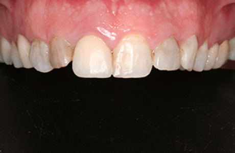 עוד מידע על ציפוי שיניים