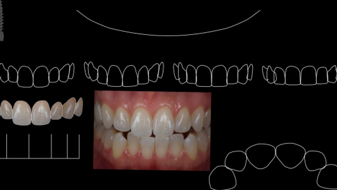 Digital Smile Design – שיטה חדשנית דיגיטלית לתכנון החיוך