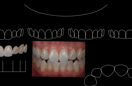 Digital Smile Design – שיטה חדשנית דיגיטלית לתכנון החיוך