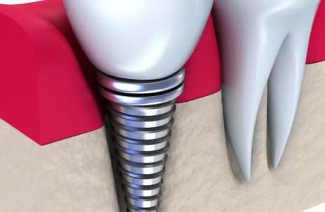 השתלות שיניים – האם הם מתאימים עבורך?