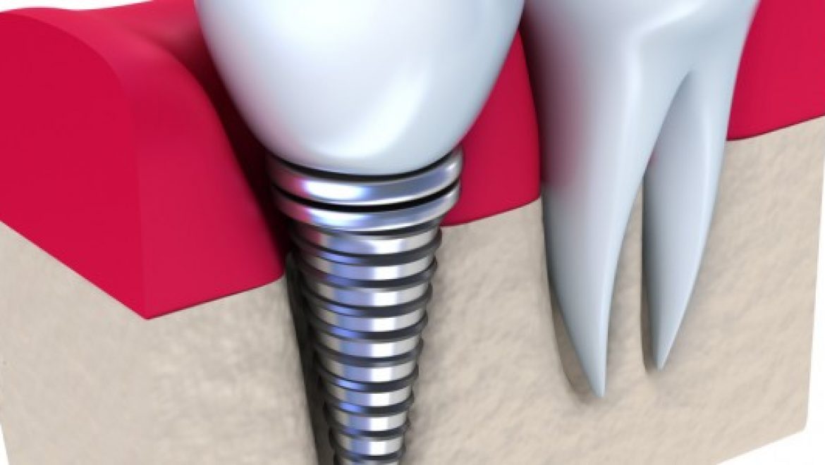 השתלות שיניים – האם הם מתאימים עבורך?
