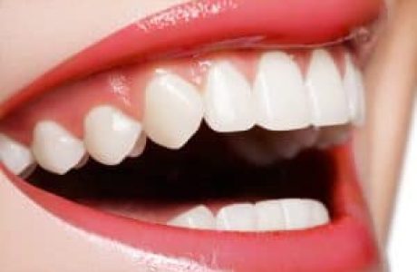 שיניים צחורות באמצעות CEREC