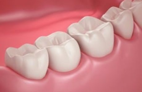 תהליך שיחזור באמצעות CEREC